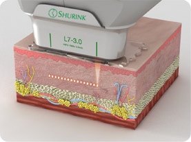 3.0mm 팁이 피부 진피층까지 열을 전달하는 단면 도해