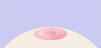 삼각피판법 1단계 — 아직 안쪽으로 함몰되어 있는 유두와 유륜을 그린 의학 일러스트