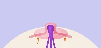 삼각피판법 3단계 — 유두가 돌출되고 아래로 보라색 유관 다발이 늘어난 단면 일러스트