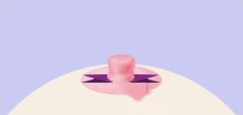 삼각피판법 4단계 — 유륜 밑에 보라·자주색 삼각형 피판 두 개가 좌우로 펼쳐진 일러스트