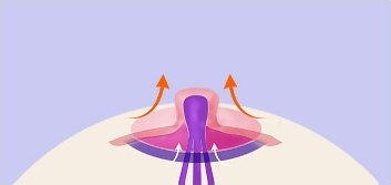 삼각피판법 5단계 — 유관 다발이 유두 아래에서 위로 뻗어 오르고 화살표가 조직을 늘리는 방향을 가리키는 단면 일러스트