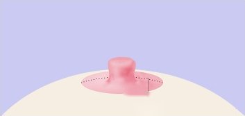 삼각피판법 6단계 — 봉합이 끝나 돌출된 유두와 유륜 둘레의 점선 봉합선을 그린 일러스트