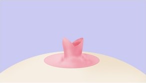 절개 — 유두 끝이 꽃잎처럼 갈라져 열린 절개 단계의 비유관보존법 도해