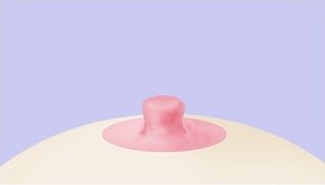 봉합 — 짧고 낮게 축소되어 봉합된 유두를 보여주는 비유관보존법 도해
