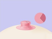 폭이 넓은 유두에 세로 절개 예정선이 점선으로 표시된 일러스트
