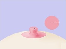 쐐기를 제거해 폭이 좁아지고 세로 점선으로 봉합된 유두 일러스트