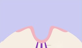 함몰유두 수술 2단계 도해 — 단면으로 본 유두가 안쪽으로 V 자로 말려 들어간 모습과 그 아래로 뻗은 보라색 유관