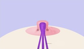함몰유두 수술 4단계 도해 — 밖으로 돌출 고정된 유두와 유륜 위 봉합점 두 개, 아래로 뻗은 보라색 유관