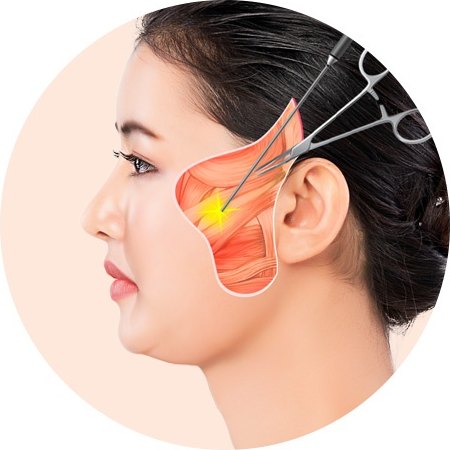 미니거상의 절개 범위와 근막층 박리 범위를 표시한 측면 얼굴 일러스트