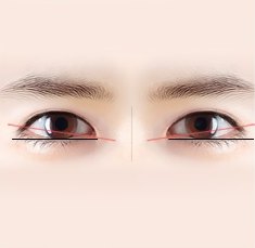 두 눈을 정면에서 본 일러스트에 눈꼬리 경사를 나타내는 빨간 사선과 검은 수평 기준선이 겹쳐진 도해