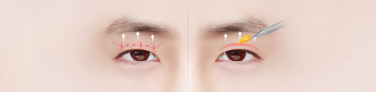 남성 눈 클로즈업 2컷을 좌우로 배치한 무쌍 눈매교정 도해 — 왼쪽은 비절개(실 매듭) 방식, 오른쪽은 절개 방식