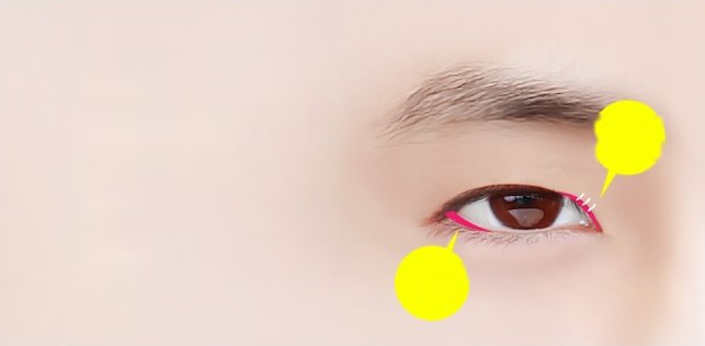 남성의 왼쪽 눈 클로즈업 — 눈 앞머리와 눈꼬리 아래에 형광 분홍 절개 표시선, 앞트임·밑트임 위치를 가리키는 노란 지시 말풍선