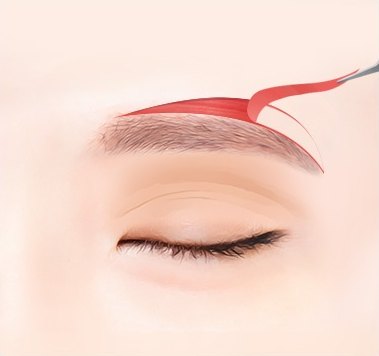 눈썹 위 늘어진 눈꺼풀 피부를 은색 메스로 절개해 붉은 피부편을 들어올리는 일러스트