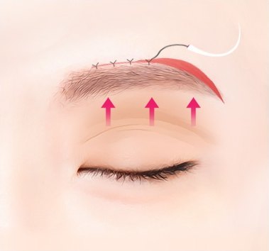 눈썹 윗선을 검은 봉합사와 곡선 바늘로 꿰매고 분홍 화살표 3개로 눈꺼풀이 당겨짐을 표시한 일러스트