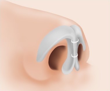 벌어진 코끝 연골을 실로 묶어 모은 단계 일러스트