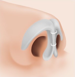 벌어진 코끝 연골을 실로 묶어 모은 단계 일러스트