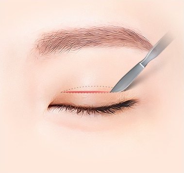 최소 절개 — 디자인 라인을 따라 눈꺼풀을 절개하는 일러스트