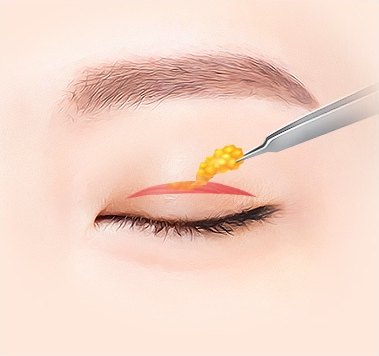 지방 및 근육 제거 — 절개창에서 지방을 집어내는 일러스트