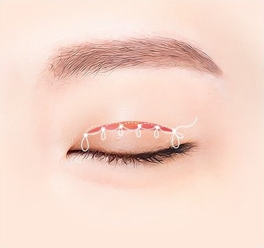 라인 고정 — 매몰 실로 쌍꺼풀 라인을 고정하는 일러스트