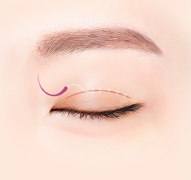 섬세 봉합 — 절개선을 곡침과 실로 봉합하는 일러스트