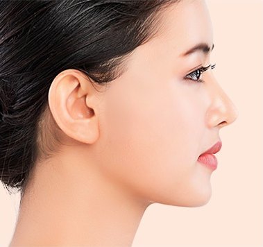 시술 후 — 볼 살이 정리되고 턱선이 뚜렷해진 여성 모델의 측면 프로필