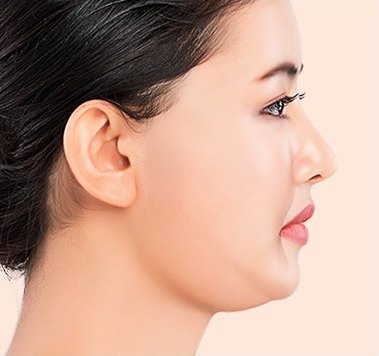 시술 전 — 볼과 턱선에 살이 도톰한 여성 모델의 측면 프로필
