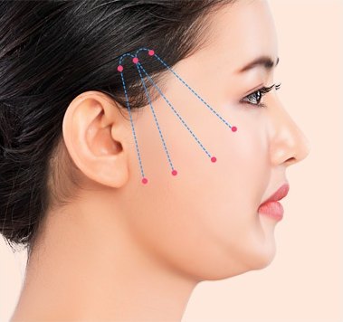 실리프팅 시술 — 관자놀이 진입점에서 볼·팔자 방향으로 실 5가닥이 뻗는 시술 디자인이 표시된 측면 프로필