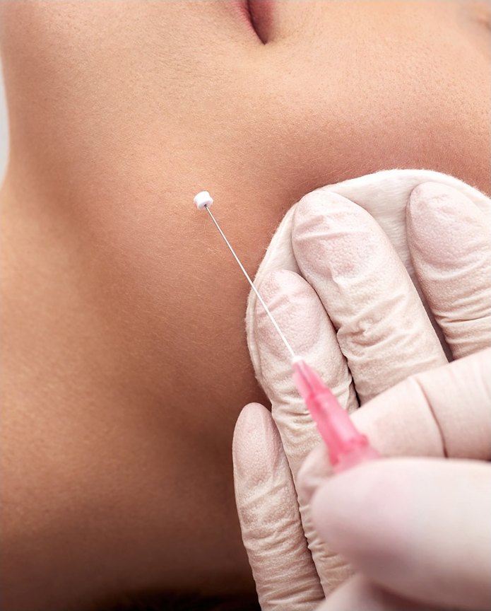 장갑 낀 시술자의 손이 분홍색 캐뉼라로 누워 있는 모델의 볼·턱선 피부에 실을 삽입하는 실리프팅 시술 클로즈업