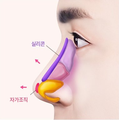 콧대에 보라색 실리콘 보형물, 코끝에 노란 자가조직을 얹은 남성 옆얼굴 단면 일러스트 (도해 표기: 실리콘, 자가조직)