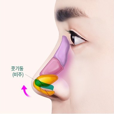 콧기둥에 초록색 자가조직을 넣어 코끝을 들어올리는 옆얼굴 단면 일러스트 (도해 표기: 콧기둥 (비주))