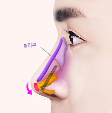 실리콘과 자가조직으로 코의 길이를 연장하는 옆얼굴 단면 일러스트 (도해 표기: 실리콘)