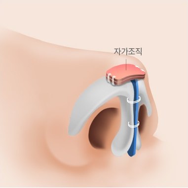 코 밑에서 본 비중격 연골 지지대와 코끝 연골 고정 봉합 일러스트 (도해 표기: 자가조직)