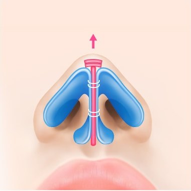 파란색으로 표시한 콧날개 연골을 모아 봉합하는 코 정면 일러스트