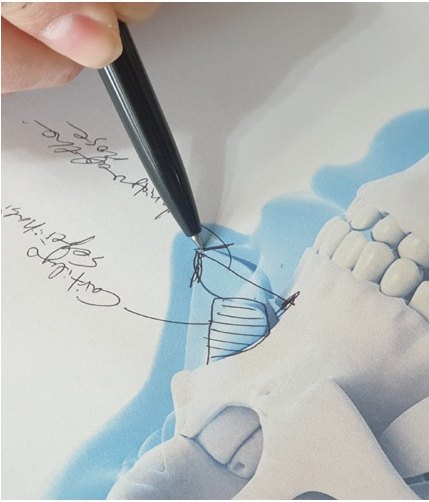 펜을 든 손이 코 해부도 위에 수술 계획선을 그리는 장면