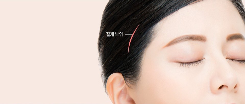 눈을 감은 여성의 관자놀이 헤어라인에 절개 부위를 산호색 곡선으로 표시한 사진