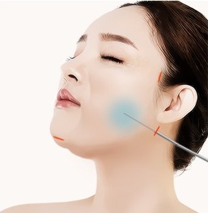 볼 부위에 튜메센트 용액을 주입하는 도해