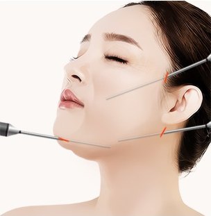 캐뉼라로 얼굴 지방을 흡입하는 도해