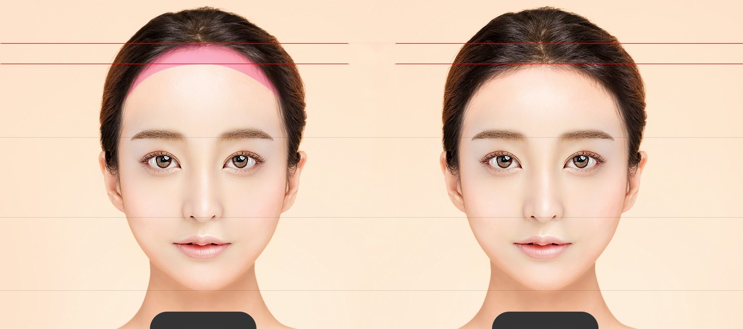 넓은 이마와 이상적인 이마를 비교한 두 얼굴과 상안면·중안면·하안면 황금비율 가이드라인