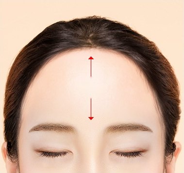 수술 전 — 얼굴 비율에 맞지 않게 이마가 넓은 상태