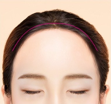 헤어라인 절개 — 앞머리 헤어라인을 따라 표시된 절개선