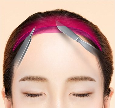 박리 — 두피를 섬세하게 박리하는 단계