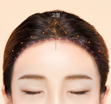 고정 및 봉합 — 뒤쪽 피판을 당겨 고정하고 봉합하는 단계, 고정 표시