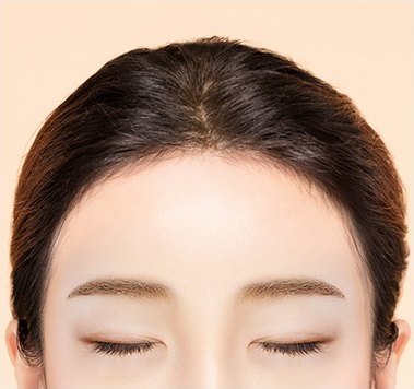 수술 후 — 넓은 이마가 좁아져 균형 있는 이마로 개선된 모습