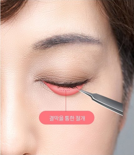 감은 눈에 수술 겸자를 대고 아래 눈꺼풀을 젖힌 클로즈업 사진. 강조 배지에 '결막을 통한 절개'라고 적혀 있다