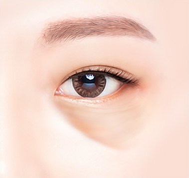 수술 전 — 눈 밑 지방이 볼록하게 튀어나오고 눈물고랑이 패인 눈 일러스트