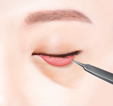 결막 절개 — 아래 눈꺼풀을 젖혀 분홍색 결막에 수술 기구를 대는 일러스트