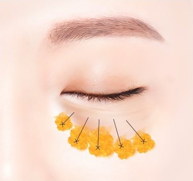 지방재배치 — 노란 지방 덩어리를 눈물고랑 쪽으로 옮기는 방향을 지시선으로 표시한 일러스트
