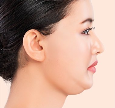 수술 전 — 얼굴과 목에 주름과 처짐이 발생한 상태의 좌측 프로필