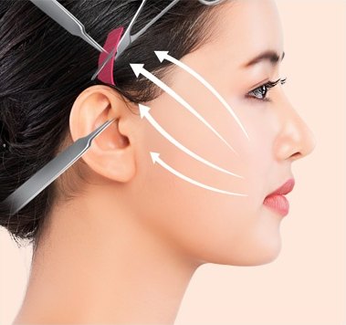 리프팅 및 남은 피부 절제 — 절제된 피부와 리프팅 방향 화살표가 표현된 도해