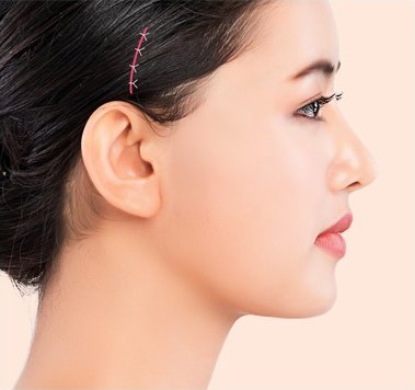 절개 부위 봉합 및 드레싱 — 측두부에 봉합선이 표시된 프로필